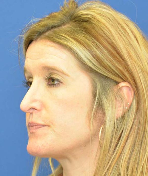 Rhinoplasty Before & After Gallery - Patient 24799487 - Image 5