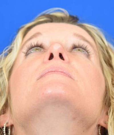 Rhinoplasty Before & After Gallery - Patient 24799487 - Image 8
