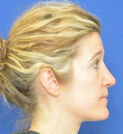 Rhinoplasty Before & After Gallery - Patient 24799487 - Image 4