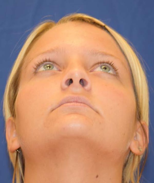 Rhinoplasty Before & After Gallery - Patient 24799488 - Image 6