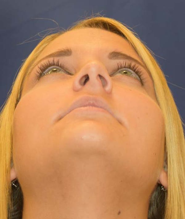 Rhinoplasty Before & After Gallery - Patient 24799488 - Image 5