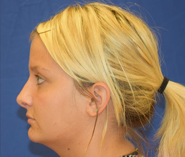 Rhinoplasty Before & After Gallery - Patient 24799488 - Image 2