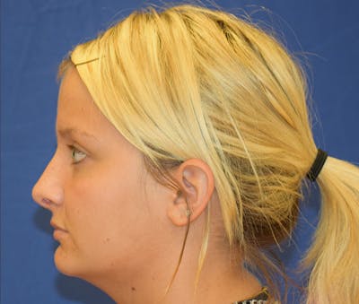 Rhinoplasty Before & After Gallery - Patient 24799488 - Image 4