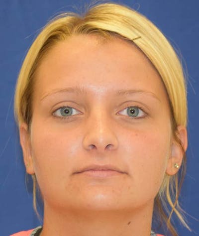 Rhinoplasty Before & After Gallery - Patient 24799488 - Image 4