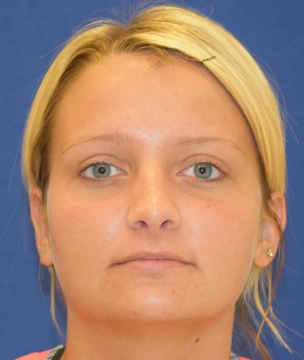 Rhinoplasty Before & After Gallery - Patient 24799488 - Image 4