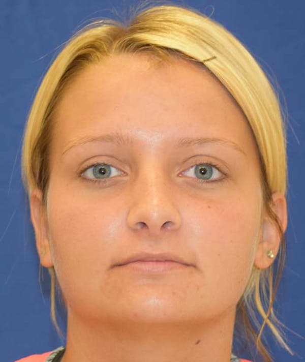 Rhinoplasty Before & After Gallery - Patient 24799488 - Image 2