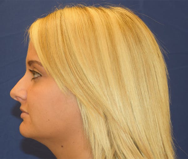 Rhinoplasty Before & After Gallery - Patient 24799488 - Image 1