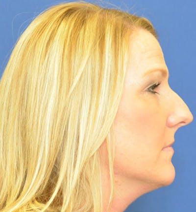 Rhinoplasty Before & After Gallery - Patient 24799489 - Image 1