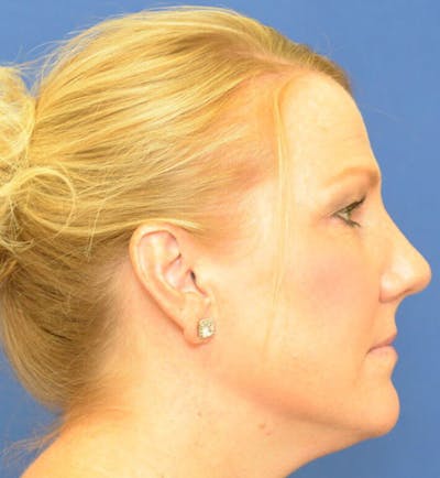 Rhinoplasty Before & After Gallery - Patient 24799489 - Image 2