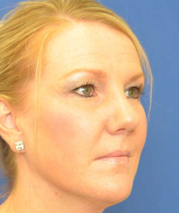Rhinoplasty Before & After Gallery - Patient 24799489 - Image 6