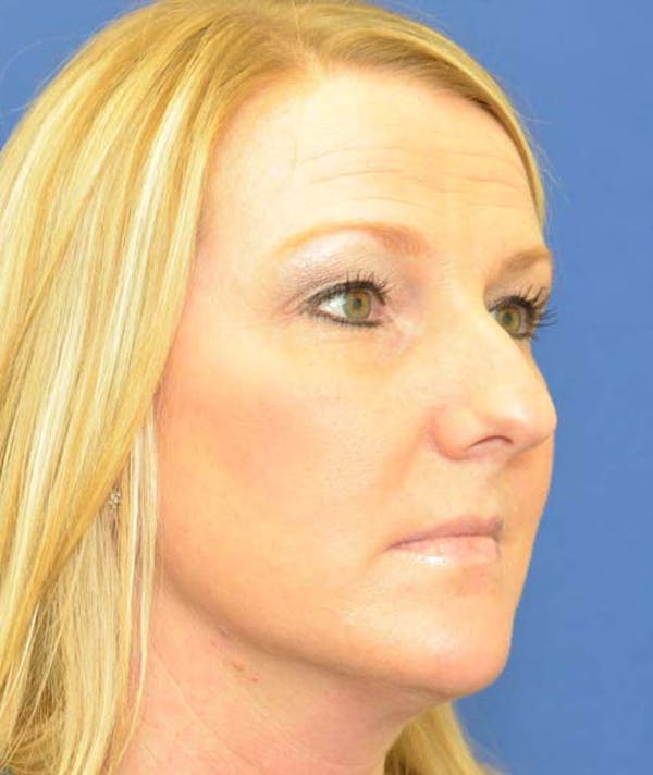 Rhinoplasty Before & After Gallery - Patient 24799489 - Image 3