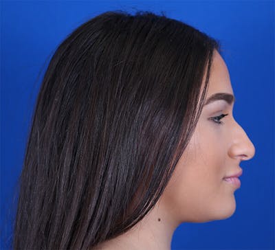 Rhinoplasty Before & After Gallery - Patient 24799490 - Image 1