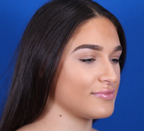 Rhinoplasty Before & After Gallery - Patient 24799490 - Image 3