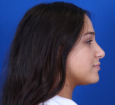 Rhinoplasty Before & After Gallery - Patient 24799490 - Image 2