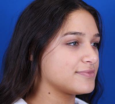 Rhinoplasty Before & After Gallery - Patient 24799490 - Image 4