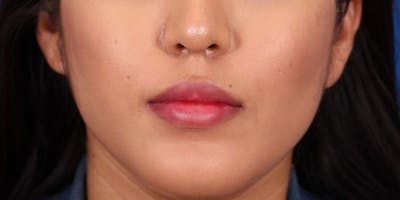 Rhinoplasty Before & After Gallery - Patient 24799686 - Image 2
