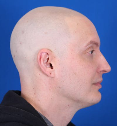 Rhinoplasty Before & After Gallery - Patient 24799687 - Image 1