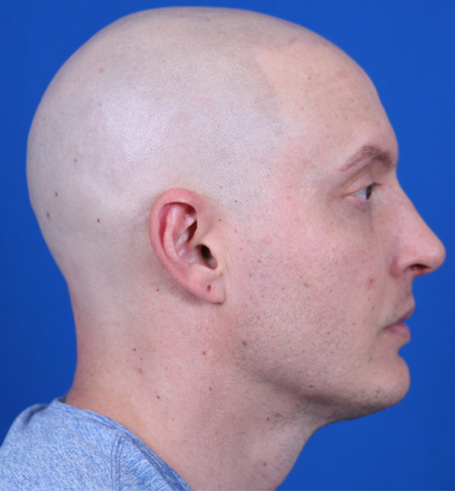 Male Rhinoplasty Omaha Nose Job for Men in Omaha