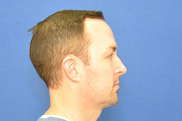 Rhinoplasty Before & After Gallery - Patient 24799689 - Image 1