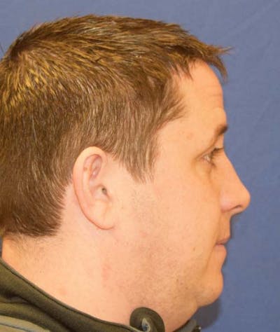 Rhinoplasty Before & After Gallery - Patient 24799688 - Image 1