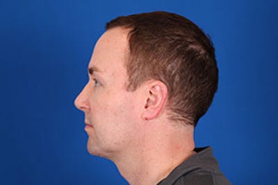 Rhinoplasty Before & After Gallery - Patient 24799689 - Image 10