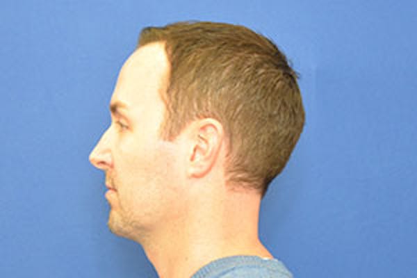 Rhinoplasty Before & After Gallery - Patient 24799689 - Image 9