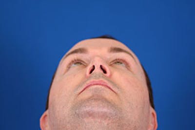 Rhinoplasty Before & After Gallery - Patient 24799689 - Image 12