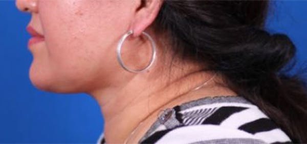Neck deFINE Before & After Gallery - Patient 24801469 - Image 2