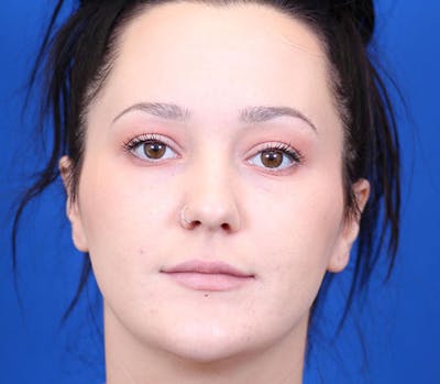 Neck deFINE Before & After Gallery - Patient 24801471 - Image 1