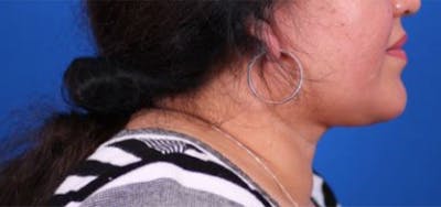 Neck deFINE Before & After Gallery - Patient 24801469 - Image 4