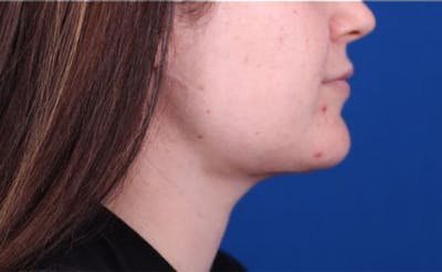 Neck deFINE Before & After Gallery - Patient 24801470 - Image 2