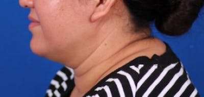 Neck deFINE Before & After Gallery - Patient 24801469 - Image 1