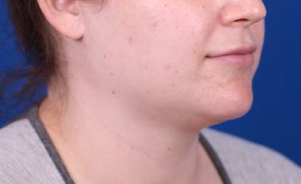 Neck deFINE Before & After Gallery - Patient 24801470 - Image 3