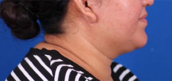 Neck Contouring Gallery - Patient 24801469 - Image 3