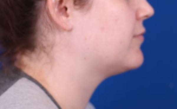 Neck deFINE Before & After Gallery - Patient 24801470 - Image 1