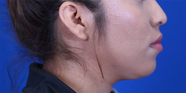 Neck deFINE Before & After Gallery - Patient 24801472 - Image 5