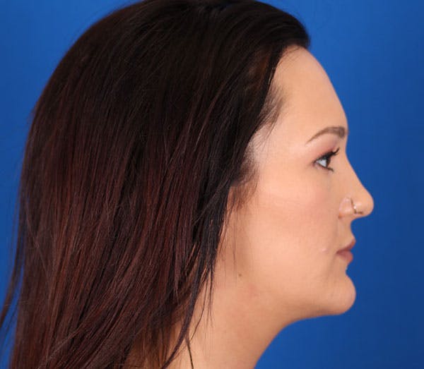 Neck deFINE Before & After Gallery - Patient 24801471 - Image 6
