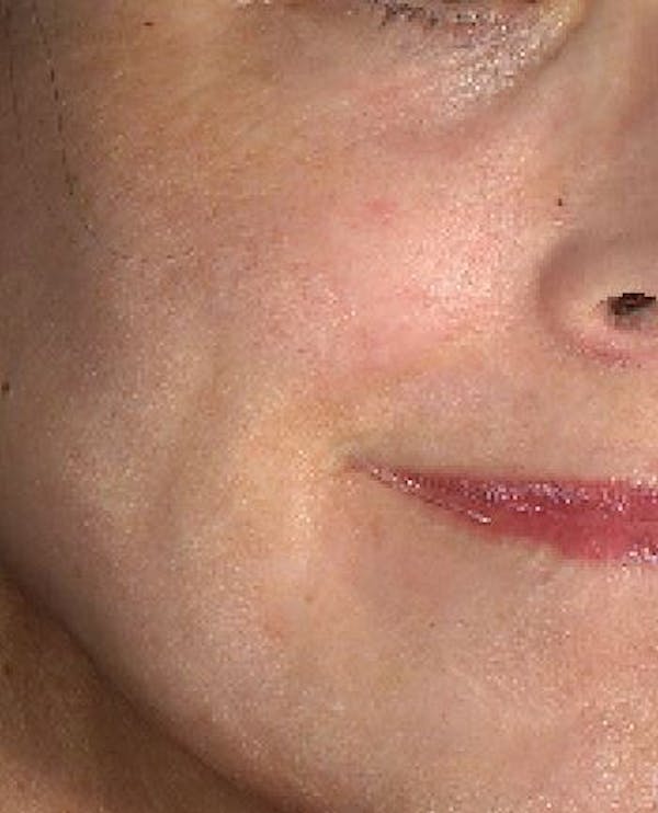 Laser Resurfacing Before & After Gallery - Patient 24801490 - Image 2