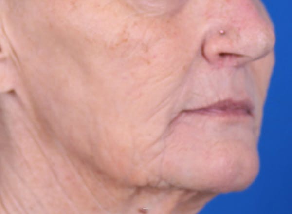 Laser Resurfacing Before & After Gallery - Patient 24801492 - Image 4