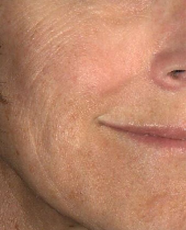 Laser Resurfacing Before & After Gallery - Patient 24801490 - Image 1