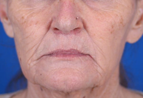 Laser Resurfacing Before & After Gallery - Patient 24801492 - Image 2