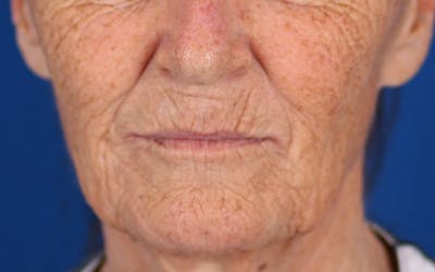 Laser Resurfacing Before & After Gallery - Patient 24801492 - Image 1