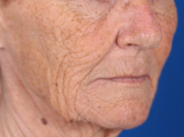 Laser Resurfacing Before & After Gallery - Patient 24801492 - Image 3