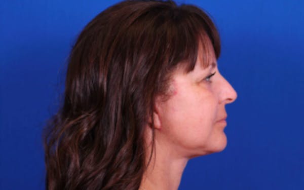 Laser Resurfacing Before & After Gallery - Patient 24801493 - Image 4