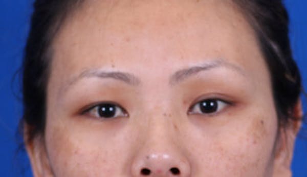 Blepharoplasty Before & After Gallery - Patient 24801515 - Image 1