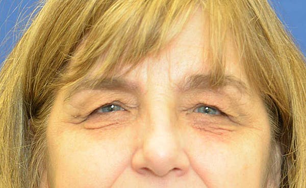 Blepharoplasty Before & After Gallery - Patient 24801516 - Image 1