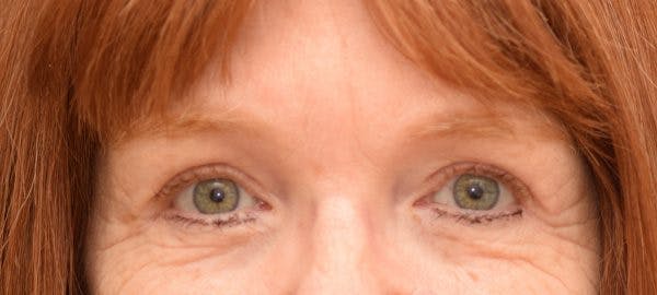 Blepharoplasty Before & After Gallery - Patient 24801517 - Image 2