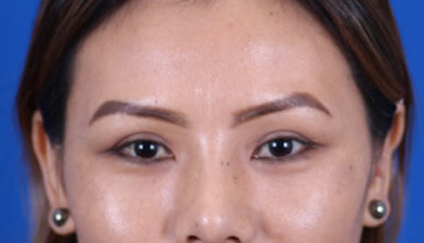 Blepharoplasty Before & After Gallery - Patient 24801515 - Image 2