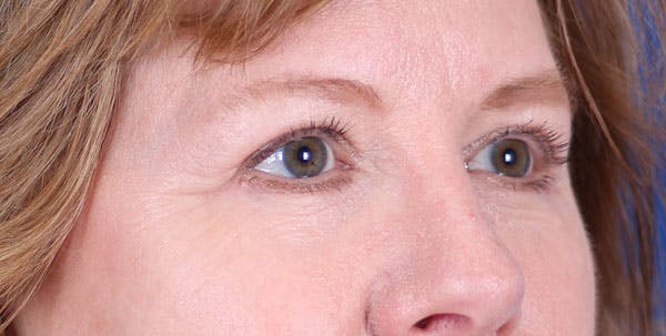 Blepharoplasty Before & After Gallery - Patient 24801518 - Image 4