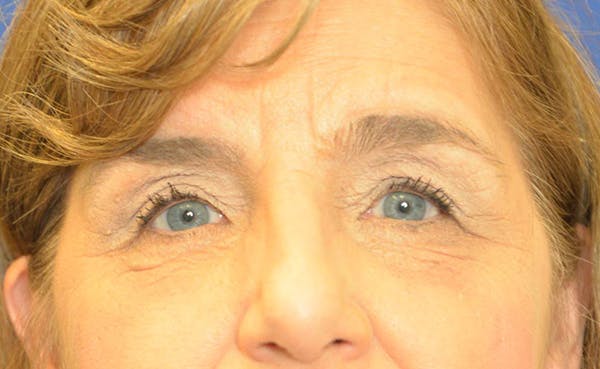 Blepharoplasty Before & After Gallery - Patient 24801516 - Image 2